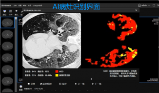 智影助诊 —— 基于多模态融合与深度学习的肺部疾病诊断系统